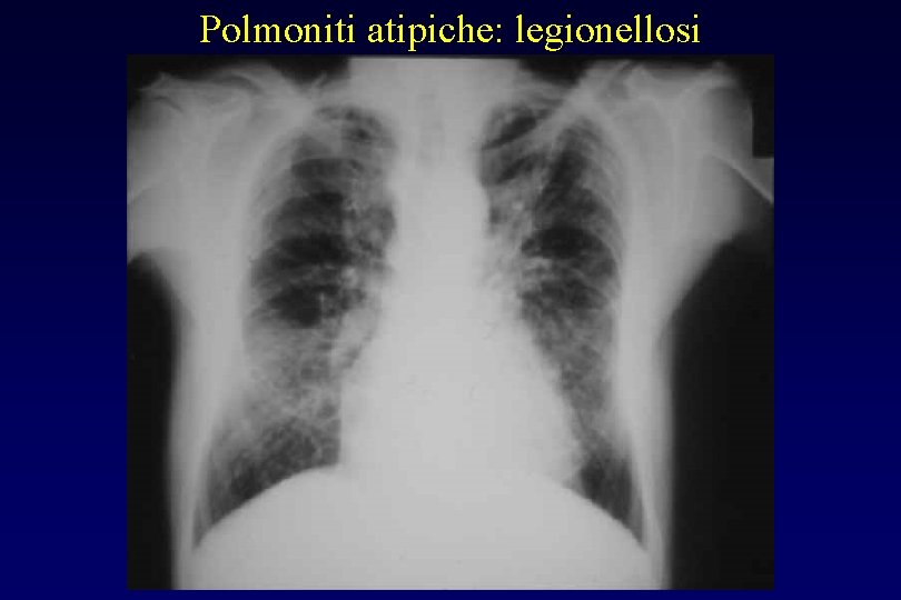 Polmoniti atipiche: legionellosi 