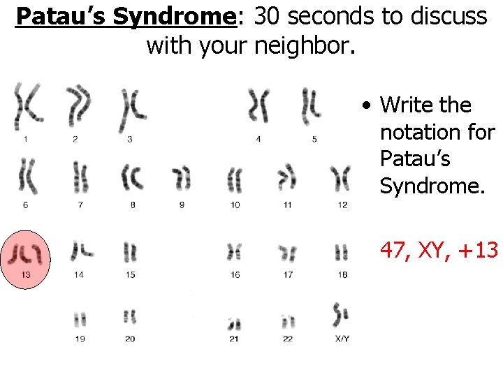 Patau’s Syndrome: 30 seconds to discuss with your neighbor. • Write the notation for