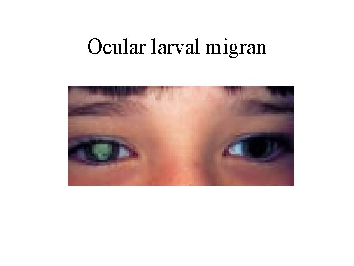 Ocular larval migran 