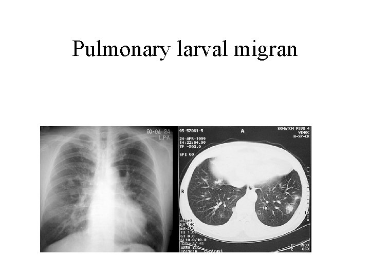 Pulmonary larval migran 