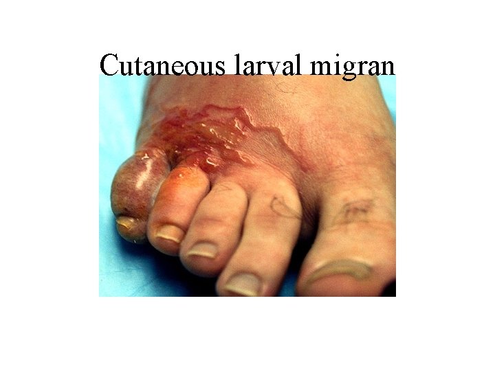 Cutaneous larval migran 