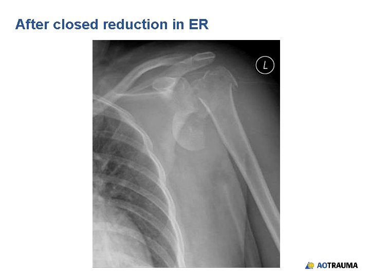 After closed reduction in ER 