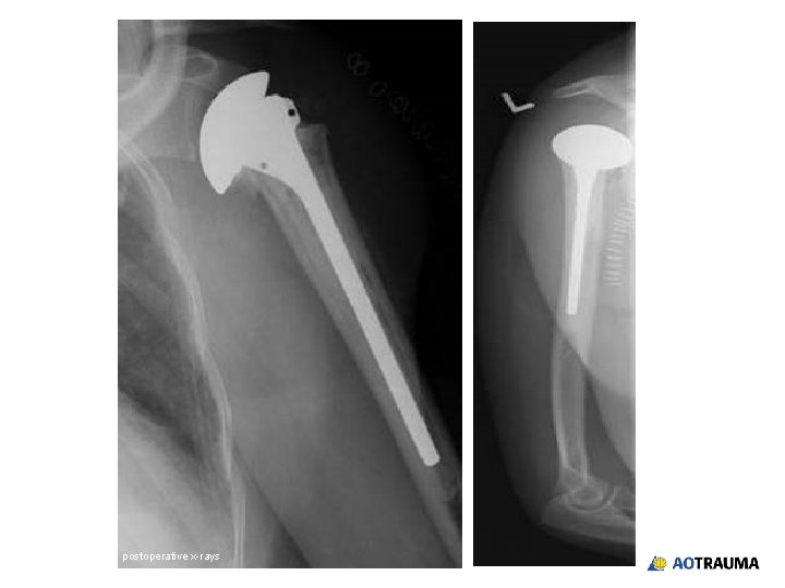 postoperative x-rays 