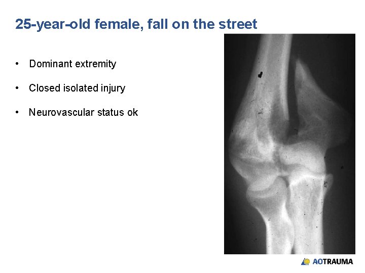 25 -year-old female, fall on the street • Dominant extremity • Closed isolated injury