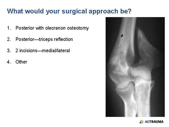 What would your surgical approach be? 1. Posterior with olecranon osteotomy 2. Posterior—triceps reflection