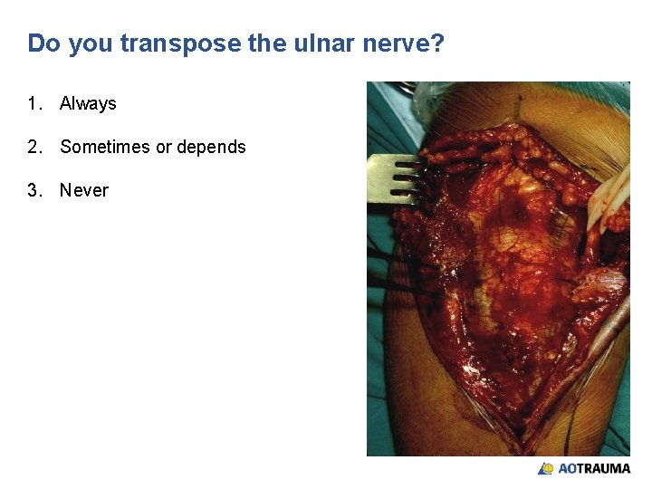 Do you transpose the ulnar nerve? 1. Always 2. Sometimes or depends 3. Never