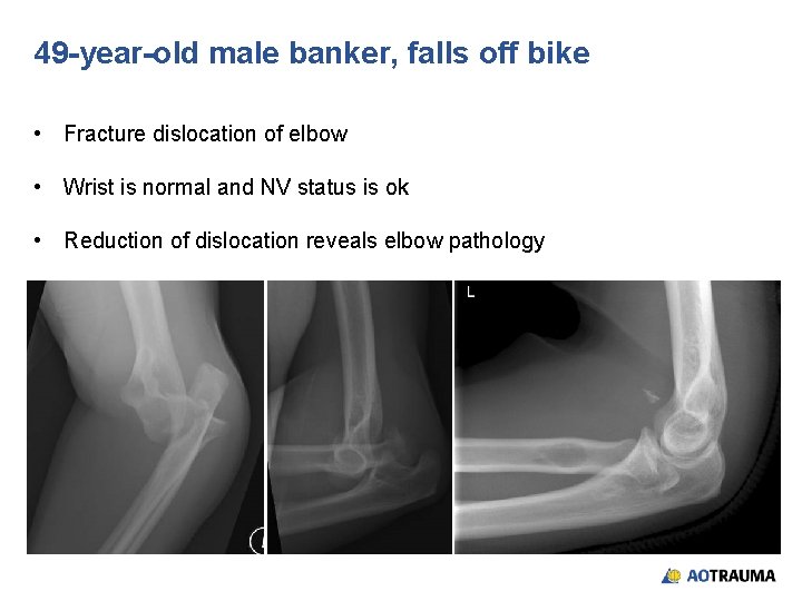 49 -year-old male banker, falls off bike • Fracture dislocation of elbow • Wrist
