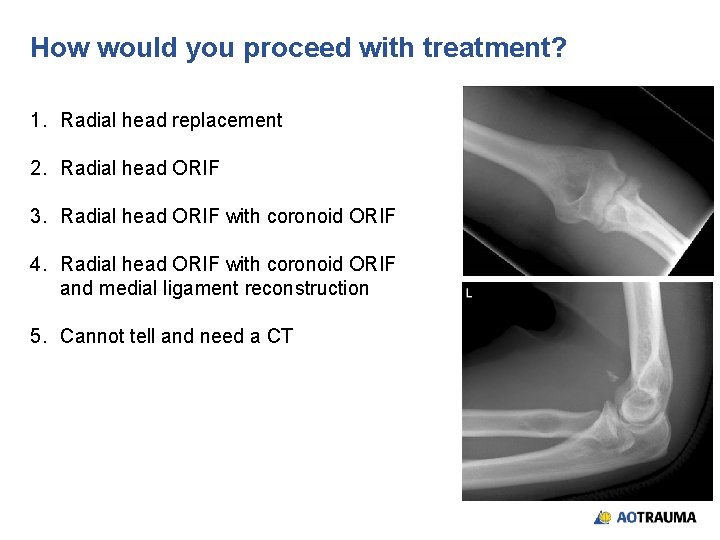 How would you proceed with treatment? 1. Radial head replacement 2. Radial head ORIF