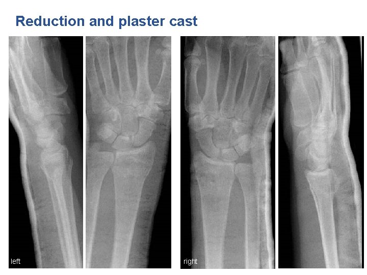 Reduction and plaster cast left right 