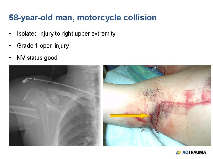 58 -year-old man, motorcycle collision • Isolated injury to right upper extremity • Grade