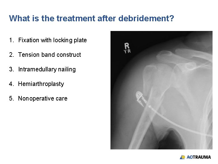 What is the treatment after debridement? 1. Fixation with locking plate 2. Tension band