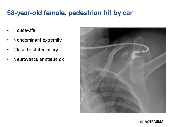 58 -year-old female, pedestrian hit by car • Housewife • Nondominant extremity • Closed