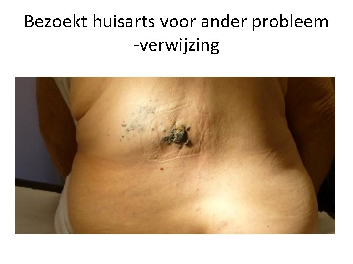 Bezoekt huisarts voor ander probleem -verwijzing 