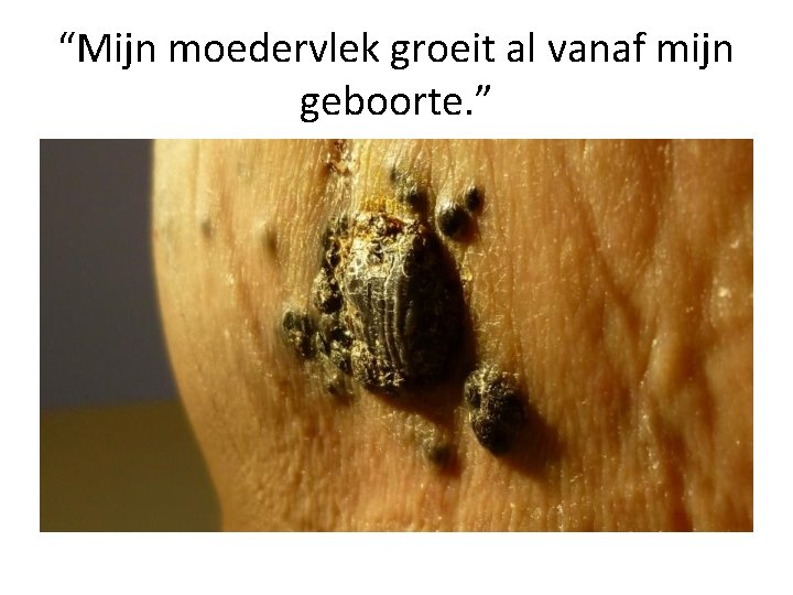 “Mijn moedervlek groeit al vanaf mijn geboorte. ” 