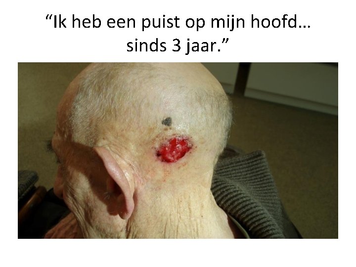 “Ik heb een puist op mijn hoofd… sinds 3 jaar. ” 