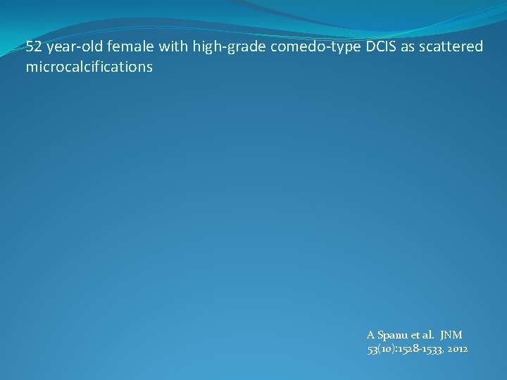 52 year-old female with high-grade comedo-type DCIS as scattered microcalcifications A Spanu et al.