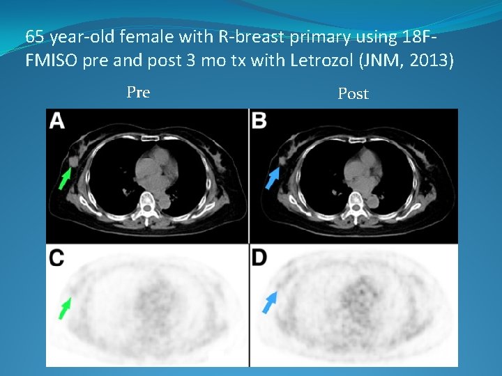 65 year-old female with R-breast primary using 18 FFMISO pre and post 3 mo