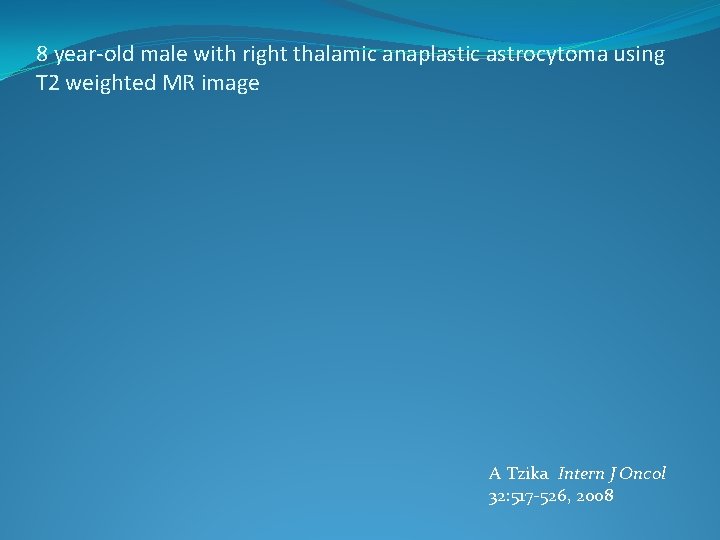 8 year-old male with right thalamic anaplastic astrocytoma using T 2 weighted MR image
