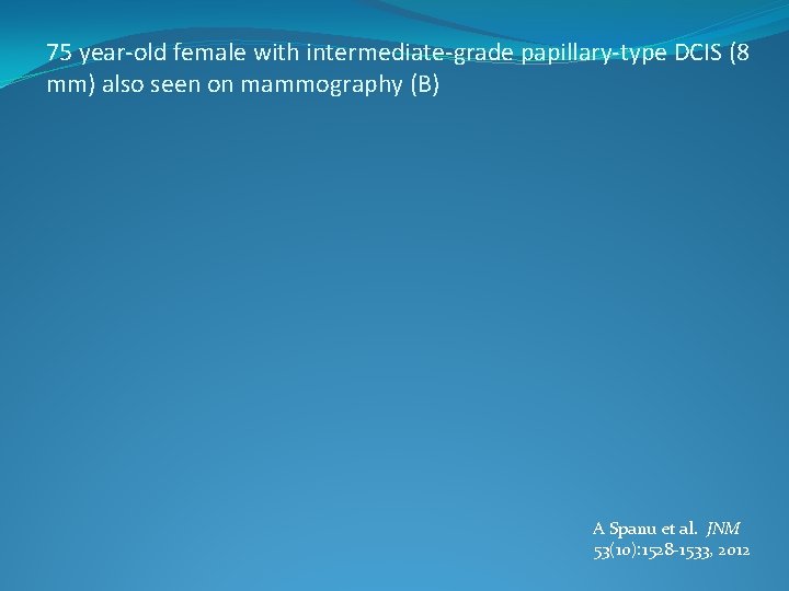 75 year-old female with intermediate-grade papillary-type DCIS (8 mm) also seen on mammography (B)