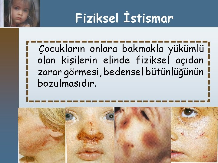 Fiziksel İstismar Çocukların onlara bakmakla yükümlü olan kişilerin elinde fiziksel açıdan zarar görmesi, bedensel