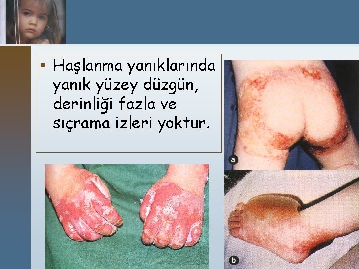 § Haşlanma yanıklarında yanık yüzey düzgün, derinliği fazla ve sıçrama izleri yoktur. 