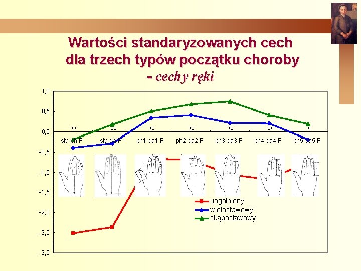 Wartości standaryzowanych cech dla trzech typów początku choroby - cechy ręki 1, 0 0,