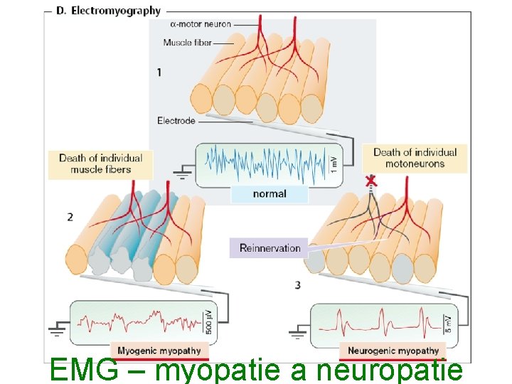 EMG – myopatie a neuropatie 