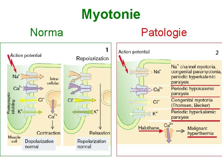 Myotonie Norma Patologie 