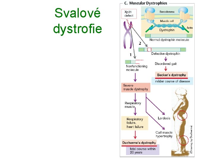 Svalové dystrofie Svalové dystrofie