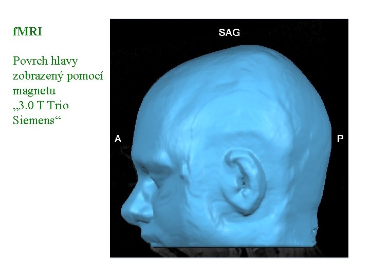 f. MRI Povrch hlavy zobrazený pomocí magnetu „ 3. 0 T Trio Siemens“ 