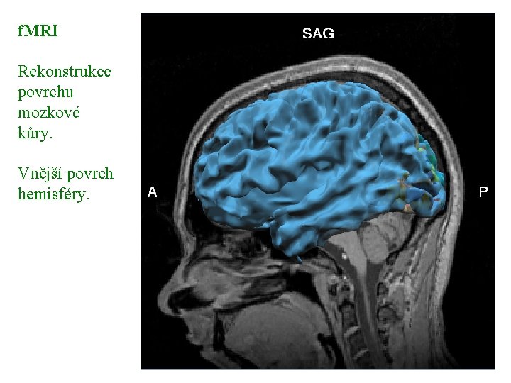 f. MRI Rekonstrukce povrchu mozkové kůry. Vnější povrch hemisféry. 