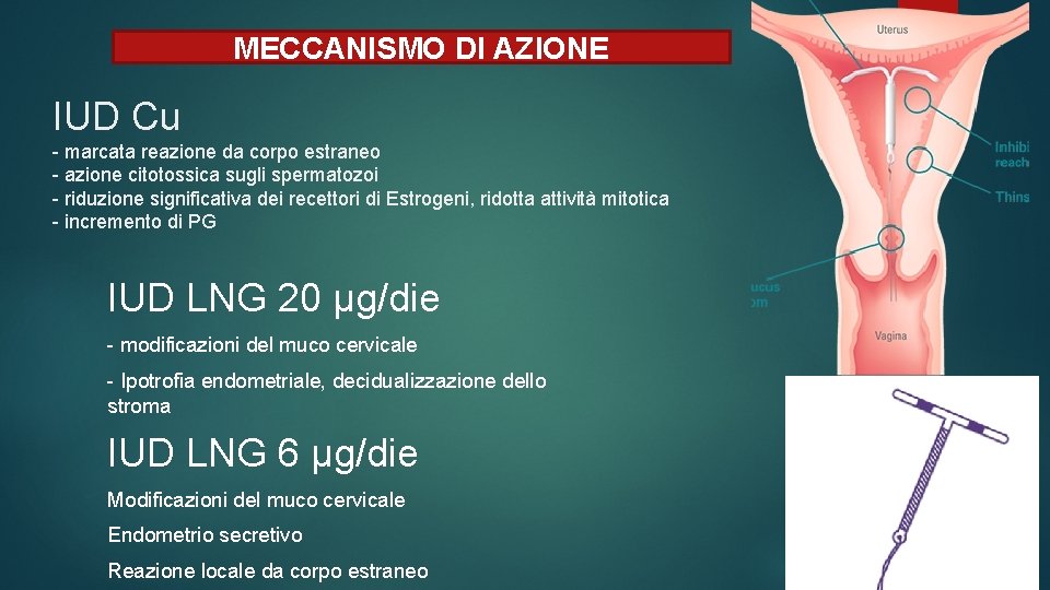 MECCANISMO DI AZIONE IUD Cu - marcata reazione da corpo estraneo - azione citotossica