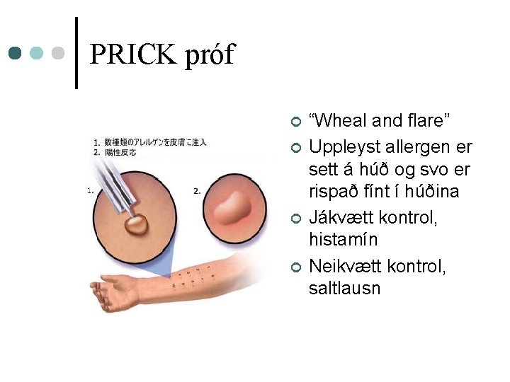 PRICK próf ¢ ¢ “Wheal and flare” Uppleyst allergen er sett á húð og