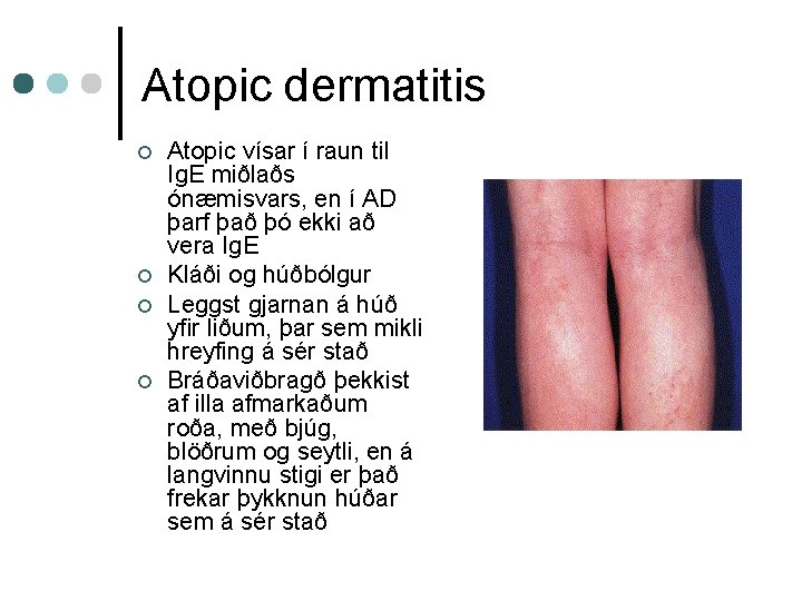 Atopic dermatitis ¢ ¢ Atopic vísar í raun til Ig. E miðlaðs ónæmisvars, en