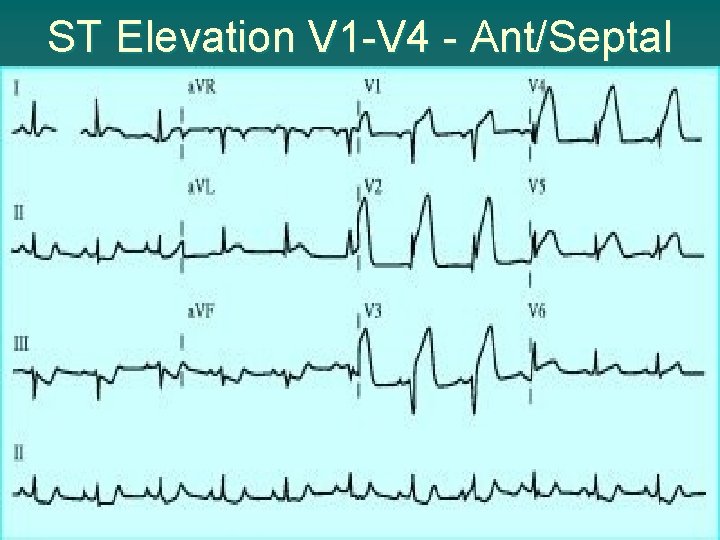 ST Elevation V 1 -V 4 - Ant/Septal 