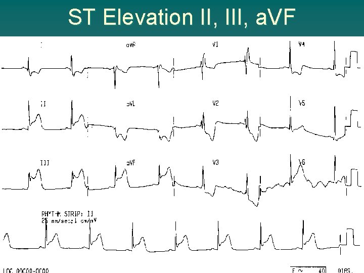 ST Elevation II, III, a. VF 