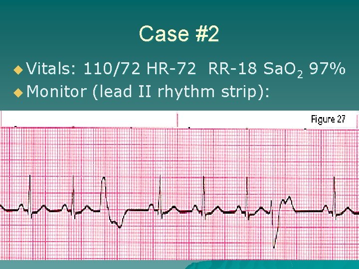 Case #2 u Vitals: 110/72 HR-72 RR-18 Sa. O 2 97% u Monitor (lead