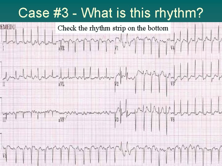 Case #3 - What is this rhythm? Check the rhythm strip on the bottom
