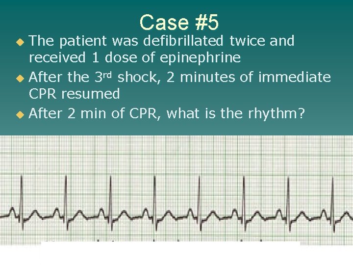 Case #5 The patient was defibrillated twice and received 1 dose of epinephrine u