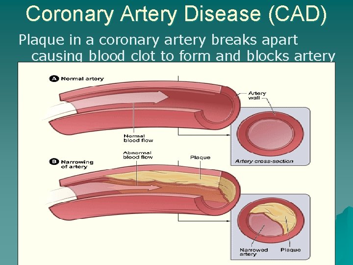 Coronary Artery Disease (CAD) Plaque in a coronary artery breaks apart causing blood clot
