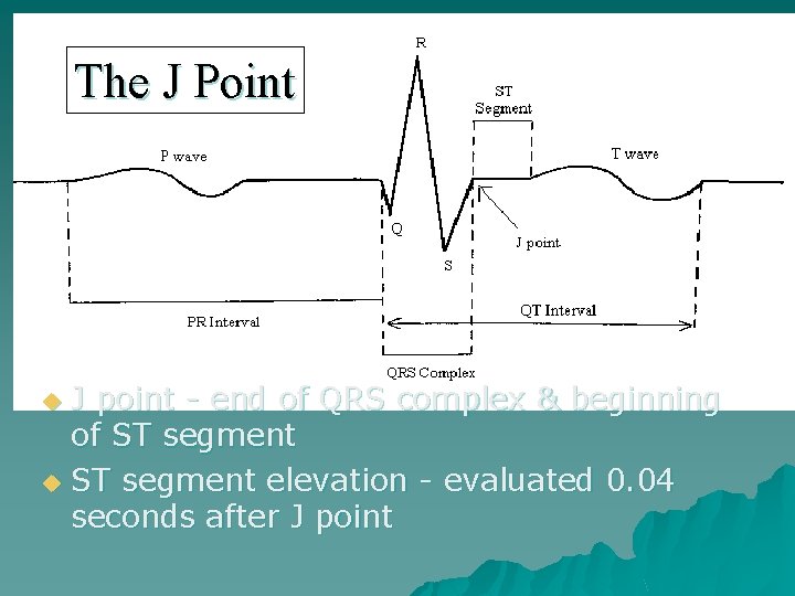 The J Point J point - end of QRS complex & beginning of ST