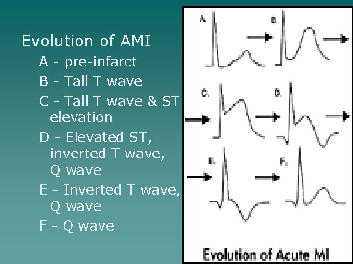 Evolution of AMI A - pre-infarct B - Tall T wave C - Tall