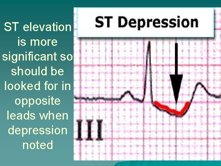 ST elevation is more significant so should be looked for in opposite leads when