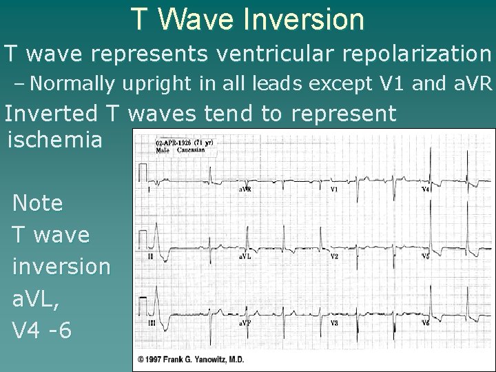T Wave Inversion T wave represents ventricular repolarization – Normally upright in all leads