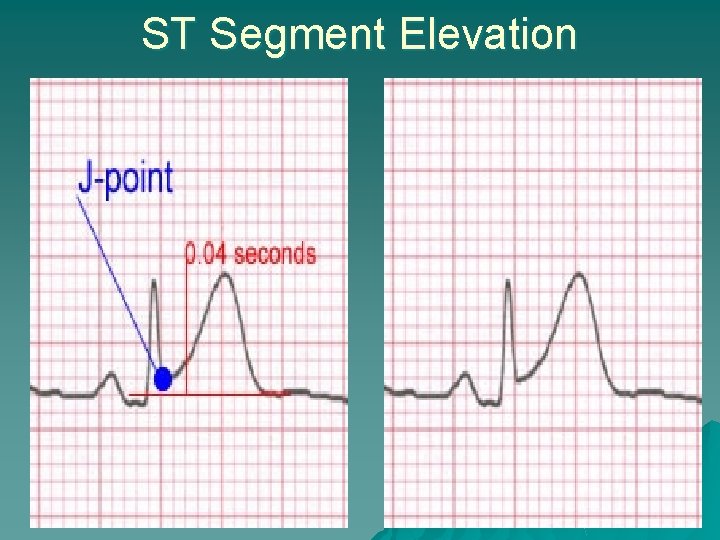 ST Segment Elevation 