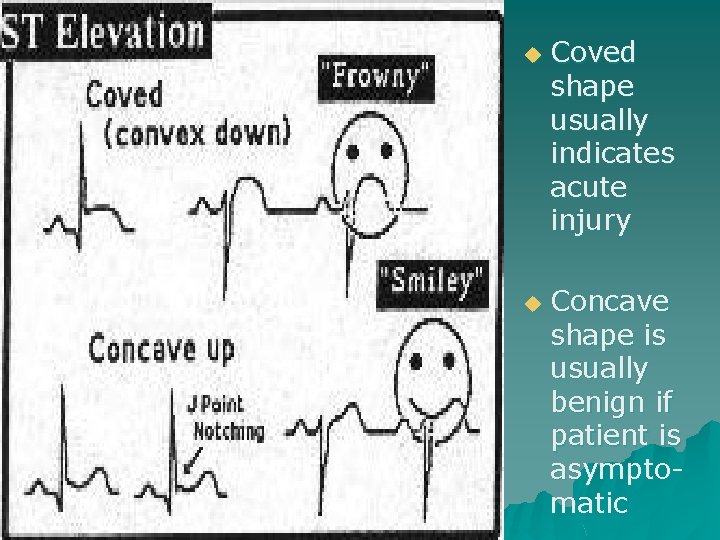 u u Coved shape usually indicates acute injury Concave shape is usually benign if