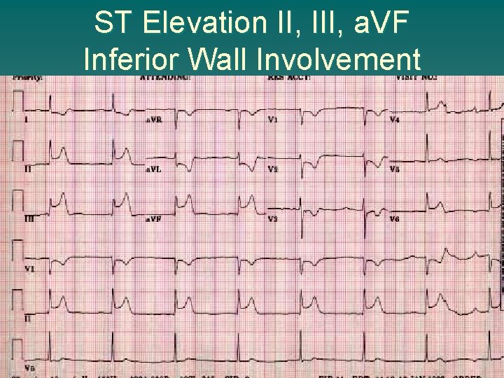 ST Elevation II, III, a. VF Inferior Wall Involvement 