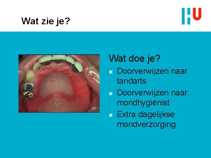 Wat zie je? Wat doe je? n n n Doorverwijzen naar tandarts Doorverwijzen naar