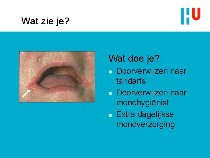 Wat zie je? Wat doe je? n n n Doorverwijzen naar tandarts Doorverwijzen naar Wat zie je? Wat doe je? n n n Doorverwijzen naar tandarts Doorverwijzen naar