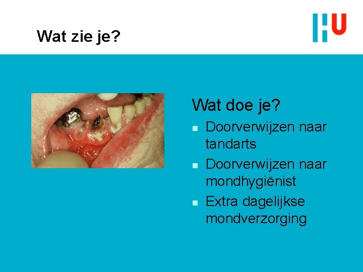 Wat zie je? Wat doe je? n n n Doorverwijzen naar tandarts Doorverwijzen naar